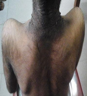 A clinical photograph capturing the posterior neck, upper back, and proximal arms of a patient, demonstrating classic manifestations of acanthosis nigricans and generalized hypertrichosis. The posterior neck displays prominent hyperpigmentation and velvety skin thickening, characteristic of acanthosis nigricans. The texture in this region appears coarse and verrucous with a cobblestone-like morphology. Concurrent with these skin changes is generalized hypertrichosis, marked by an abnormal density of fine, dark hair covering the shoulders, upper back, and posterior arms. These findings are clinically significant as they often serve as cutaneous markers for underlying metabolic or endocrine disorders, such as severe insulin resistance or lipodystrophy syndromes. The image is a valuable educational resource for dermatology and endocrinology, illustrating the co-occurrence of paraneoplastic or metabolic skin signs.