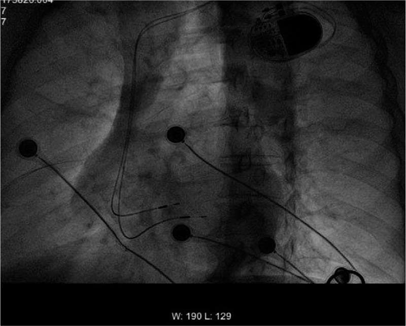 This diagnostic image is a fluoroscopic radiograph (radioscopy) of the chest in a left anterior oblique (LAO) projection, demonstrating the placement of a cardiac rhythm management device. A dual-chamber pacemaker generator is visible in the upper right pectoral region. Two electrode leads extend from the generator into the heart. One lead is positioned specifically at the interventricular septum, likely targeting the His bundle or left bundle branch region for physiological pacing, while the other lead provides backup or additional chamber sensing. Multiple external circular radiopaque ECG monitoring electrodes are also visible across the chest wall. The anatomical landmarks include the cardiac silhouette, the spinal column, and the rib cage. This image serves as an educational example of physiological pacing lead placement, specifically illustrating the orientation of 3830-style pacing leads directed toward the septum to treat conduction system disorders like atrioventricular block.