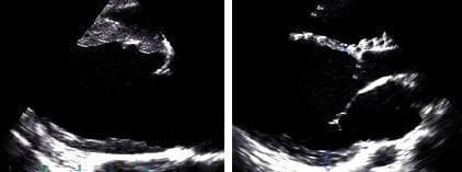 This clinical imaging figure consists of two side-by-side grayscale echocardiogram still frames focusing on the left heart chambers of a 63-year-old female patient. The diagnostic images illustrate key features of cardiovascular pathology associated with heart failure and atrial fibrillation. Centrally, the left ventricle is visible, showing moderately thickened myocardial walls consistent with left ventricular hypertrophy. The endocardial borders and chamber dimensions are delineated, reflecting decreased left ventricular diastolic function. While valve structures are partially visible, they are not the primary focus of these specific frames. The imaging serves as a clinical demonstration of the structural remodeling and hemodynamic changes seen in chronic cardiac conditions, including atrial fibrillation and congestive heart failure. These visual findings are relevant for medical students and clinicians studying cardiac ultrasound indicators like ejection fraction (LVEF) and ventricular geometry in the context of cardiovascular disease management.