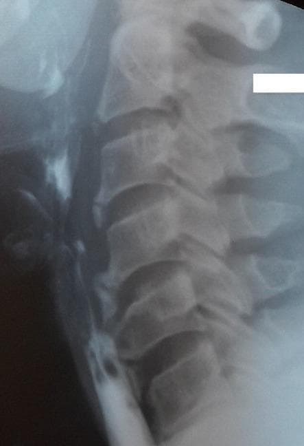 This diagnostic image is a lateral cervical X-ray combined with a barium swallow study. It depicts the cervical spine from C2 to C7 and the adjacent esophagus. Prominent anterior flowing osteophytes and ossification of the anterior longitudinal ligament are visible along the vertebral bodies, characteristic of Diffuse Idiopathic Skeletal Hyperostosis (DISH) or Forestier's disease. The barium contrast highlights the esophageal lumen, demonstrating a significant extrinsic compression and narrowing at the level of the C5-C6 vertebrae caused by these large anterior bony outgrowths. This finding provides a radiological explanation for mechanical dysphagia. The image serves as a clinical example of how degenerative spinal changes can impact adjacent soft tissue structures in the neck, specifically the upper digestive tract.
