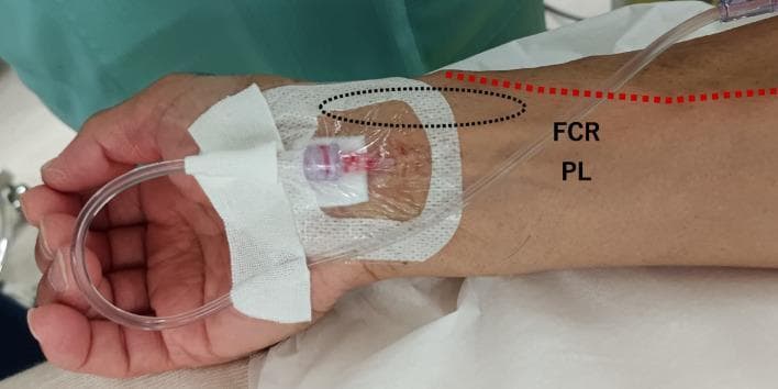 This clinical photograph illustrates an anatomical variation and its impact on arterial cannulation in the distal forearm. The image shows a right wrist with an arterial catheter secured in place. Annotations highlight the procedural anatomy: the catheter is positioned between the flexor carpi radialis (FCR) and palmaris longus (PL) tendons, a location corresponding to the course of the median nerve and median artery. A dashed black oval indicates the traditional site for radial artery palpation, where the pulse was difficult to identify. A red dashed line traces the path of a superficial radial artery, an anatomical variant that crosses over the anatomical snuffbox. This procedural image demonstrates incidental median artery cannulation, a clinical scenario encountered when standard radial access is complicated by vascular anomalies. It serves as an educational tool for anesthesiology and critical care training, emphasizing the importance of ultrasound guidance and awareness of forearm vascular variations to avoid unintentional cannulation of vessels associated with major nerves.