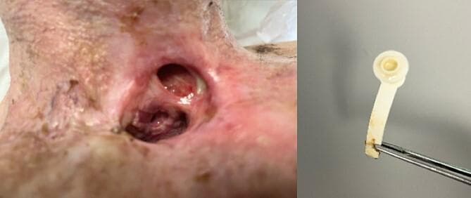 This composite clinical image illustrates complications following a total laryngectomy, specifically a pharyngocutaneous fistula and a degraded tracheoesophageal prosthesis (TEP). The left image is a clinical photograph of the anterior neck, showing a permanent tracheostomy stoma. Superior to the primary stoma, there is a second, smaller opening consistent with a pharyngocutaneous fistula. The surrounding peristomal skin is erythematous, friable, and exhibits signs of chronic irritation and potential infection. Internal mucosal surfaces are visible, showing varied coloration from healthy pink to dark, congested tissue. The right image displays a removed TEP held by forceps against a neutral background. The prosthesis, constructed of off-white polymer, shows significant extrinsic staining and structural degradation. The distal end appears irregular and frayed, suggesting erosion or material failure. This visual pair demonstrates the clinical presentation of TEP-related complications, including fistula formation and hardware failure, which are critical in otolaryngology and head and neck surgery education.
