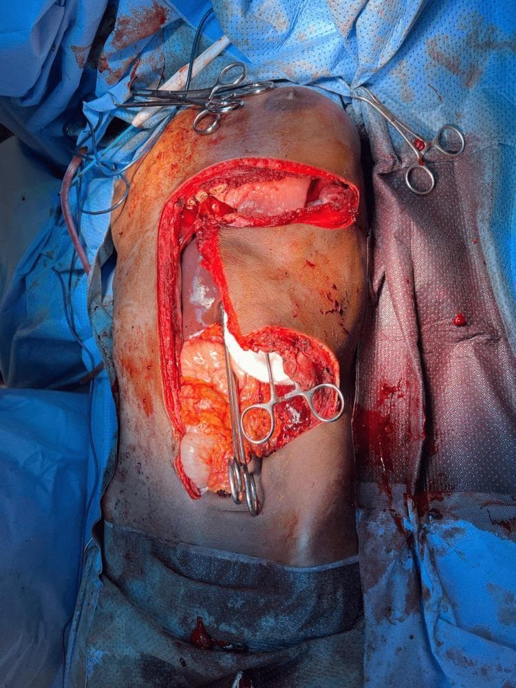 An intraoperative clinical photograph demonstrating an exploratory laparotomy using a thoracoabdominal approach. The image shows a large T-shaped surgical incision on the torso, consisting of a vertical midline abdominal incision and a horizontal left-sided transverse extension into the thoracic region. This wide exposure reveals the abdominal and lower thoracic cavities. Visible within the surgical field are various anatomical structures, including a dark red solid organ (likely the displaced spleen or liver) and a large, pale, lobulated soft tissue mass in the left upper quadrant. Several surgical instruments, including hemostatic clamps and retractors, are positioned along the skin edges and within the cavity to maintain surgical access. The surgical site is draped with blue sterile cloths, and there is evidence of minor hemorrhage consistent with an active procedure. This image illustrates the surgical access required for the resection of large retroperitoneal or diaphragmatic-herniating masses.