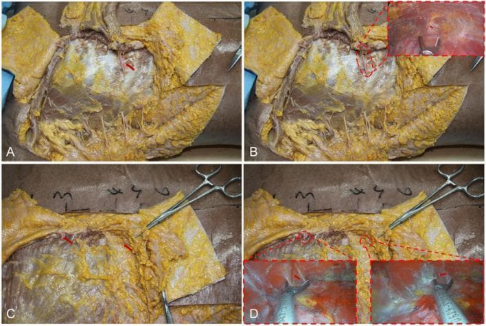 This composite of four clinical photographs (A-D) demonstrates the surgical anatomy of the chest wall relevant to transaxillary endoscopic breast augmentation. Figure A shows a dissected view of the fourth intercostal space with a red arrow identifying a vascular bundle emerging from the intercostal region toward the pectoralis major muscle. Figure B includes an endoscopic inset showing the visualization of this vascular anatomy in a lower pocket. Figure C illustrates the medial boundary near the lateral edge of the sternum, where red arrows point to neurovascular bundles located in the 2โ3 and 4โ5 intercostal spaces. Figure D demonstrates the surgical management of these vessels using an ultrasonic scalpel, with endoscopic insets showing the precise disconnection of the intercostal perforators. The images highlight critical landmarks for creating the subpectoral cavity while protecting nipple sensation and minimizing postoperative hematoma. Key structures visible include the pectoralis major, intercostal muscles, adipose tissue, and various surgical instruments used for blunt and sharp dissection.