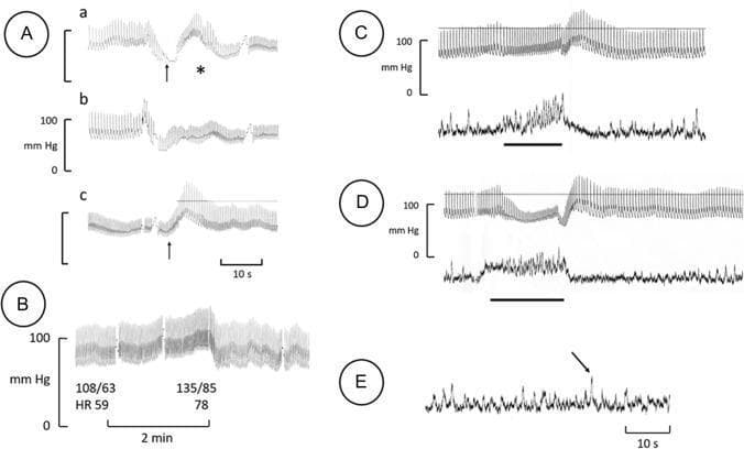 This physiological tracing panel illustrates cardiovascular and autonomic nervous system responses in a patient with orthostatic hypotension. Panel A shows continuous blood pressure (BP) recordings during postural transitions from lying to standing, highlighting rapid hypotension leading to presyncope and the compensatory effect of leg crossing (arrow in 'c'). Panel B displays a qualitatively normal hypertensive and tachycardic response to sustained handgrip. Panels C and D provide integrated microneurography recordings of muscle sympathetic nerve activity (MSNA, lower traces) alongside BP (upper traces). In Panel C (apnea test), a marked increase in MSNA precedes a rise in BP, with subsequent sympathetic inhibition during the post-apnea BP rebound. Panel D (Valsalva maneuver) demonstrates a similar pattern: initial sympathetic activation during the strain phase followed by profound inhibition during the phase IV BP overshoot. Panel E illustrates skin sympathetic nerve activity (SSNA) at rest, showing a characteristic arousal response (arrow). These findings help evaluate baroreceptor-governed sympathetic outflow and peripheral autonomic integrity in neurogenic orthostatic disorders.