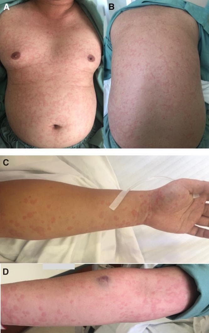 Clinical photograph series showing skin manifestations of dengue fever in a 25-year-old male. Panels A and B display the anterior (chest/abdomen) and posterior (back) trunk, revealing a generalized, pruritic eruption. The rash is characterized by erythematous wheals that are partially confluent, creating a map-like or mottled appearance with areas of normal skin interspersed. Panels C and D show similar lesions on the upper extremities, demonstrating raised, irregularly shaped, pink-to-red wheals across the forearms and wrists. A singular ecchymosis (bruise) is visible on the distal forearm in panel D. The morphology is consistent with urticarial-like lesions frequently observed in the early stages of viral exanthems. The images serve as an educational reference for recognizing atypical dermatological presentations of dengue virus infection, distinguishing them from classic petechial rashes.