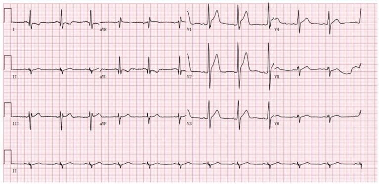 A standard 12-lead electrocardiogram (ECG) recorded on pink grid paper, showing a sinus rhythm. The tracing demonstrates several abnormal waveform morphologies characteristic of cardiac involvement in Duchenne Muscular Dystrophy (DMD). Notable features include significantly tall R waves in the right precordial leads (V1, V2, and V3), with an R/S ratio greater than 1 in V1, which may mimic right ventricular hypertrophy or posterior wall involvement. The limb leads reveal a left axis deviation consistent with a left anterior fascicular block (LAFB), characterized by small q waves with tall R waves in leads I and aVL, and small r waves with deep S waves in leads II, III, and aVF. There is poor R-wave progression across the precordial leads, and the QRS complexes in V4–V6 show relatively lower voltages compared to the prominent right precordial R waves. These findings are clinically significant for identifying cardiomyopathy and conduction system abnormalities in patients with progressive muscular dystrophies.
