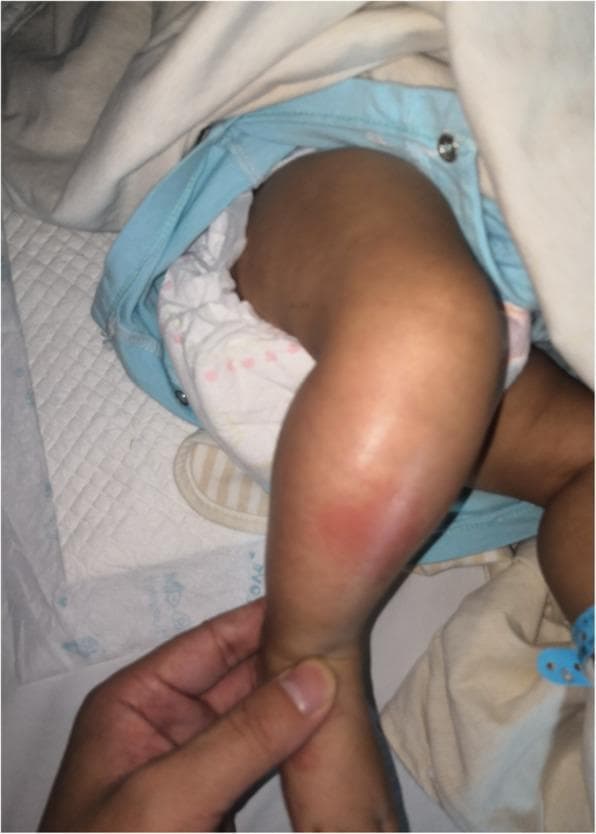 This clinical photograph displays the right lower leg of a 2-month-old infant in a hospital setting. The image demonstrates significant localized pathology characterized by marked edema (swelling) and overlying erythema (redness) on the anteromedial aspect of the proximal to mid-tibia region. The skin appears tense and shiny due to the underlying inflammatory process. A clinician's hand is visible stabilizing the ankle, providing scale and indicating a physical examination. The patient is situated on a medical underpad, wearing a diaper and hospital-issued clothing, which establishes the pediatric clinical context. This visual presentation is highly suggestive of acute inflammatory or infectious processes of the soft tissue or underlying bone, such as cellulitis or acute osteomyelitis. The educational focus is on the pediatric physical manifestation of musculoskeletal infection and the visual cues of inflammation—rubor (redness) and tumor (swelling)—in an infant.