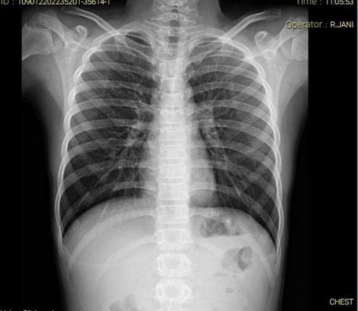This diagnostic image is a posterior-anterior (PA) chest X-ray of a pediatric patient, demonstrating normal cardiopulmonary and skeletal anatomy. The radiograph shows clear lung fields without evidence of focal consolidations, opacities, or pleural effusions. The bronchovascular markings are within normal limits, extending from the hilar regions. The cardiomediastinal silhouette is normal in size and contour, with a clearly defined heart border and visible trachea positioned centrally. The diaphragm appears smooth and dome-shaped bilaterally, with clear costophrenic angles. Skeletal structures, including the clavicles, ribs, scapulae, and the thoracic vertebral column, appear intact without evidence of acute fractures, dislocations, or degenerative changes. The image serves as a clinical baseline for a normal chest examination in a pediatric surgical context, specifically used here to rule out respiratory involvement in a patient with abdominal symptoms.