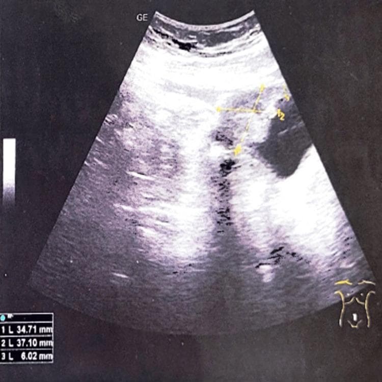 This diagnostic ultrasound image in sagittal view demonstrates the pelvic region, specifically focusing on the urinary bladder. A significant, solid, heterogeneous mass is visible originating from the bladder dome (anterosuperior wall). The lesion displays mixed echogenicity with irregular borders compared to the adjacent bladder wall. Electronic calipers measure the tumor dimensions as approximately 34.71 mm by 37.10 mm. The bladder lumen appears relatively clear of internal debris. This imaging finding is characteristic of a bladder dome tumor, which in this clinical context is associated with a urachal remnant or urachal adenocarcinoma. The image serves as an educational example of identifying bladder wall thickening and localized masses using transabdominal sonography, emphasizing the importance of evaluating the dome for urachal pathology.