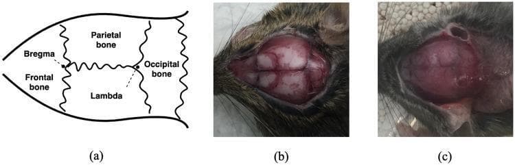 This figure provides a comparative study of mouse cranial anatomy, focusing on critical landmarks for stereotactic neurosurgery. Panel (a) is a schematic diagram illustrating the dorsal view of the skull, identifying the frontal, parietal, and occipital bones separated by sutures. Key reference points are labeled: 'Bregma' (the intersection of coronal and sagittal sutures) and 'Lambda' (the intersection of sagittal and lambdoid sutures). Panel (b) is a clinical photograph of an exposed rodent skull displaying clear visibility of these cranial sutures as dark, irregular lines against the pale bone, with clearly discernible bregma and lambda points. Panel (c) shows a similar surgical exposure where these anatomical landmarks are obscured by soft tissue, vascular markings, or anatomical variation, presenting a challenge for manual stereotactic positioning. The image illustrates the variability in anatomical clarity encountered during neurosurgical procedures in rodent models, emphasizing the educational importance of landmark identification and the potential for computer-guided or deep learning-based localization to improve precision in instrument insertion.