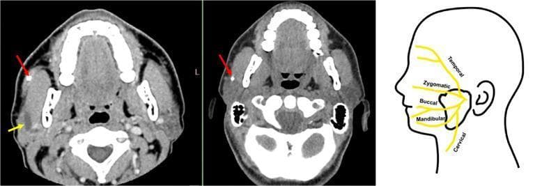 This composite educational image features two diagnostic CT scans and one anatomical diagram focusing on the right parotid gland region. The first and second panels are axial CT slices of the head and neck. The left-most panel (current admission) demonstrates a hyperdense sialolith (red arrow) within the right Stensen's duct, accompanied by a dilated ductal segment (yellow arrow) and soft tissue swelling within the right parotid gland compared to the contralateral side. The middle panel shows a prior CT from six months earlier, highlighting the same sialolith (red arrow) in a more posterior position and smaller size, illustrating disease progression and anterior displacement. The third panel is an anatomical line drawing of a lateral profile of the head, showing the parotid gland and the branching patterns of the facial nerve (CN VII), including the temporal, zygomatic, buccal, mandibular, and cervical branches. This figure serves as a comparative study of sialolithiasis, demonstrating diagnostic imaging of ductal obstruction and the relevant regional anatomy for surgical or interventional planning in otolaryngology.
