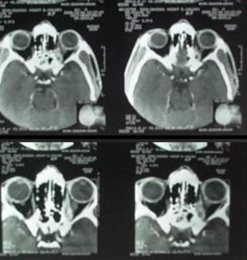 This diagnostic image consists of axial slices from a computerized tomography (CT) scan of the orbits. The imaging demonstrates the anatomy of the ocular globes, extraocular muscles, and posterior orbital structures. In the left orbit, there is significant thickening of the medial rectus and superior rectus muscles. Within these thickened muscles, multiple small, well-defined, non-enhancing hypodense lesions are visible, particularly in the posterior aspect. One prominent lesion within the superior rectus muscle displays a central hyperdense dot, characteristic of a scolex, which is highly suggestive of orbital cysticercosis. The pathology is seen to approximate the optic canal, potentially causing compression or thickening of the optic nerve. This case illustrates a classic radiological presentation of parasitic infection localized to the extraocular muscles, resulting in inflammatory myositis and associated clinical symptoms such as ptosis and restrictive ocular motility. The scan is a key educational tool for distinguishing orbital inflammatory conditions and infectious myositis in ophthalmology and radiology.