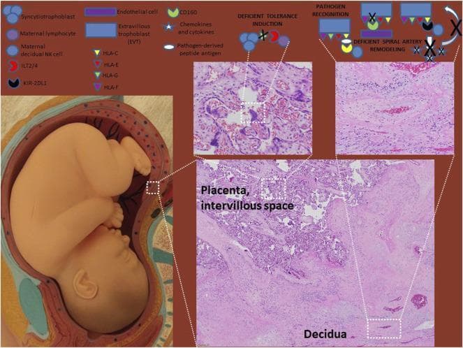 This composite educational infographic illustrates the pathophysiology of preeclampsia at the maternal-fetal interface. It combines a gross anatomical model of a fetus in utero with H&E-stained histopathological sections and a schematic immunological diagram. The histology displays the placental intervillous space, characterized by branched chorionic villi and syncytiotrophoblasts, adjacent to the maternal decidua. A schematic legend identifies key immune mediators, including HLA-C, HLA-E, HLA-G, and HLA-F, alongside maternal lymphocytes and decidual NK cells (dNK). The diagram contrasts normal pregnancy physiology with pathological states in preeclampsia, specifically highlighting 'Deficient Tolerance Induction' and 'Deficient Spiral Artery Remodeling.' It depicts how impaired interactions between extravillous trophoblasts (EVTs) and maternal immune cells—mediated by specific HLA-receptor bindings like HLA-G with ILT2/4 and HLA-C with KIR-2DL1—contribute to shallow trophoblast invasion and failed vascular transformation of decidual spiral arteries. Black 'X' marks denote inhibited pathways, signaling failures in pathogen recognition and chemokine/cytokine release necessary for healthy placental development.