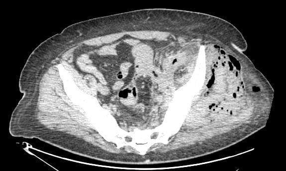 This diagnostic image is an axial computed tomography (CT) scan of the pelvis demonstrating significant pathology within the soft tissues. The most prominent finding is the presence of extensive gas collections (emphysema) within the left gluteal and left psoas musculature, appearing as multiple low-attenuation (dark) punctate foci and larger confluent pockets. The gas is seen dissecting through the muscle fibers and along the fascial planes, which is a hallmark finding of necrotizing fasciitis or gas-forming infections. There is associated swelling and distortion of the normal muscular architecture on the left side compared to the right. The scan also shows evidence of retroperitoneal involvement, with gas extending along the psoas muscle. This visual information is critical for diagnosing surgical emergencies like necrotizing soft tissue infections (NSTI) and determining the extent of required debridement. The imaging provides anatomical context for the spread of sepsis from retroperitoneal sources, such as perforated diverticulitis, into the musculoskeletal compartments of the pelvis and lower limb.