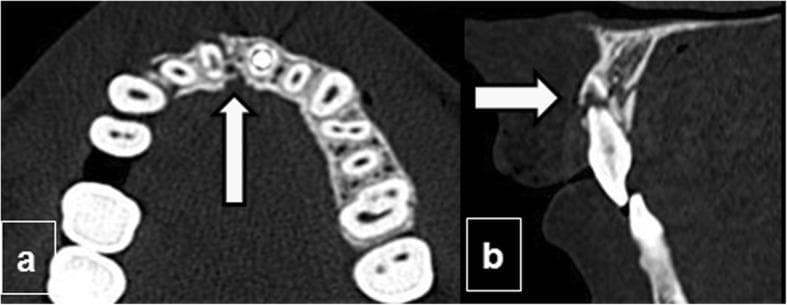 This unenhanced Computed Tomography (CT) study of the facial skeleton demonstrates traumatic injuries to the maxilla and dentition across two planes. Image (a) is an axial section showing a fracture of the upper alveolar process. A dark, linear lucency (indicated by an arrow) signifies a cortical discontinuity and disruption of the alveolar ridge's normal contour near the anterior midline. The fracture exhibits mild comminution and displacement of the surrounding bone fragments. Image (b) is a sagittal reconstruction revealing a dental root fracture of an upper incisor. The fracture is visualized as a transverse radiolucent line (arrow) passing through the root, resulting in a loss of longitudinal structural continuity. These findings are characteristic of maxillofacial trauma, highlighting the clinical significance of CT in assessing alveolar bone integrity and associated dental complications like root fractures or avulsions. The images illustrate key diagnostic criteria for surgeons and radiologists evaluating middle-third facial fractures and the status of the maxillary dental buttress.