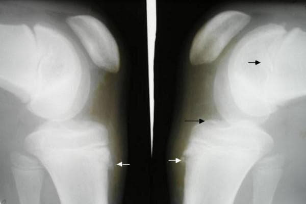 This lateral knee radiograph comparison displays bilateral skeletal structures of the knee joints, including the distal femur condyles, patellae, and proximal tibiae. The images demonstrate classic features of Osgood-Schlatter disease, characterized by bilateral irregularity and fragmentation of the tibial tuberosity apophyses. Distinct white arrows highlight the areas of bony avulsion or separation where the patellar tendon inserts into the tibial tubercle. Black arrows point to associated osteochondral changes and the articulation space. The radiographs were captured with 10-20 degrees of internal rotation. Visible hallmarks include the prominence and fragmentation of the tibial tubercle and soft tissue thickening in the infrapatellar region. These findings are clinically significant for diagnosing traction apophysitis in adolescent patients presenting with anterior knee pain and point tenderness over the tibial tuberosity.