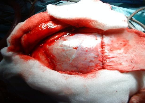This clinical photograph captures a per-operative view of an open craniotomy during a neurosurgical procedure. The focal point of the image is the exposed brain surface, specifically the cerebral cortex, displaying characteristic gyri and sulci covered by the arachnoid mater. The surgical field is bounded by retracted scalp tissue and white surgical sponges or gauze used for hemostasis and to maintain field clarity. Significant sanguineous fluid (blood) is visible around the margins of the cranial opening. To the right of the primary cortical exposure, a linear suture line is visible on the reflected dural or scalp flap, indicating a phase of tissue approximation or closure. This image serves as an educational example of a large craniotomy, typical in procedures such as the Arana-Iniguez technique for the surgical management of intracranial lesions like hydatid cysts.