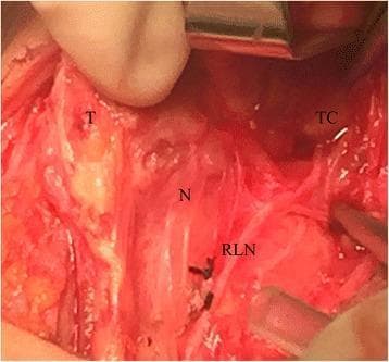An intraoperative clinical photograph documenting an anatomical variation of the recurrent laryngeal nerve (RLN) during a thyroid surgery. The image shows the surgical field with the following landmarks labeled: the thyroid gland (T) medially retracted, the thyroid cartilage (TC) in the superior-lateral aspect, and the point of typical nerve entry (N). The recurrent laryngeal nerve (RLN) is visualized following an atypical trajectory, ascending along the medial margin of the superior thyroid pole and terminating beneath the superior cornu of the thyroid cartilage. This clinical case illustrates an anatomical variant that can lead to surgical complications if not properly identified. The surgical site displays typical tissue characteristics including erythematous vascularized structures and surgical retraction tools. This image serves as an educational resource for endocrine surgeons and medical students to understand neurovascular anatomy and the importance of intraoperative nerve monitoring in preventing iatrogenic vocal cord paralysis.