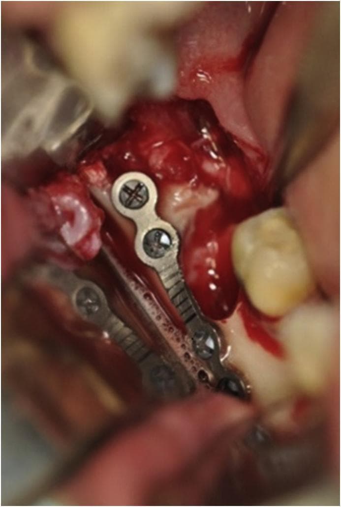 This clinical photograph shows an intraoperative view of an oral and maxillofacial surgical procedure. A 2.0 mm titanium miniplate has been installed along the external oblique line of the mandibular angle. The miniplate features a four-hole bridge design, with monocortical screws secured into the bone. The screws exhibit cross-shaped (Phillips) drive heads. The central bridge section of the plate is narrower than the ends and contains small circular perforations with a ridged surface texture. The surgical field displays exposed yellowish-white cortical bone, hyperemic soft tissue, and some fresh blood at the extraction site of a lower third molar. Adjacent dentition is visible in the background, providing anatomical orientation. This procedure demonstrates the prophylactic use of rigid internal fixation (Champy's technique) to reinforce a weakened mandible and prevent late fractures following the extraction of a deeply impacted third molar in a patient with significant bone thinness.