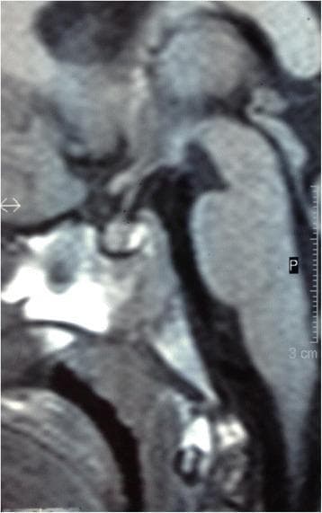 This diagnostic image is a sagittal precontrast T1-weighted MRI focusing on the sellar and suprasellar regions. It depicts the pituitary gland within the sella turcica. The image shows a homogeneous enlargement of the pituitary gland, which measures approximately 7 mm in height. A distinctive feature is the convex upper surface of the gland, which differs from the typically flat or concave surface seen in younger pediatric patients. The posterior lobe of the pituitary gland (neurohypophysis) is clearly identified by its characteristic hyperintense signal (bright spot) on the T1-weighted sequence. The anterior lobe (adenohypophysis) appears normal in signal intensity but contributes to the overall increased volume. Key anatomical landmarks visible include the optic chiasm superior to the gland and the sphenoid sinus inferiorly. This clinical imaging serves to illustrate physiological or pathological pituitary enlargement, often evaluated in the context of rapid growth or endocrine dysfunction.