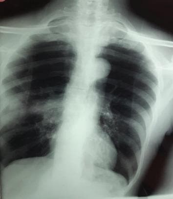 This diagnostic image is a posteroanterior (PA) chest radiograph demonstrating significant pulmonary pathology within the right lung field. The primary finding is a dense, homogeneous opacity located in the right hilar region, suggesting a central mass or tumoral process. Additionally, a distinct peripheral nodular opacity is visible in the right middle-to-upper lung zone. This nodule exhibits irregular, spiculated contours, which are often indicative of a malignant or infiltrative process. The left lung field appears relatively clear by comparison, and the cardiac silhouette and mediastinal contours are visible, though the right hilum is obscured by the primary mass. This radiograph illustrates key radiological features of potential bronchogenic carcinoma, specifically the 'hilar mass' and associated peripheral 'spiculated nodule.' The image serves as an educational example for identifying lung cancer manifestations on standard X-ray imaging for medical students and radiology residents.