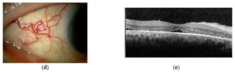 This composite educational image features a clinical photograph and a diagnostic Optical Coherence Tomography (OCT) scan illustrating ocular inflammation.