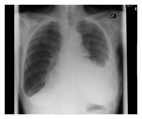 This diagnostic image is a posterior-anterior (PA) chest X-ray of an adult patient. The primary finding is a large, homogenous opacity in the left lower and middle hemithorax, which completely obscures the left costophrenic angle and left hemidiaphragm silhouette. This appearance is characteristic of a large left-sided pleural effusion, showing a classic meniscus sign where the fluid level curves upwards along the lateral chest wall. The opacity also partially silhouettes the left heart border. In contrast, the right lung field appears clear with sharp costophrenic and cardiophrenic angles. The mediastinal structures are centrally located, though the cardiac silhouette is obscured on the left. This radiograph serves as a clinical example of significant pleural fluid accumulation, useful for teaching radiographic signs such as silhouette sign and meniscus formation. The clinical context suggests an exudative effusion potentially associated with carbimazole therapy, a rare adverse effect.
