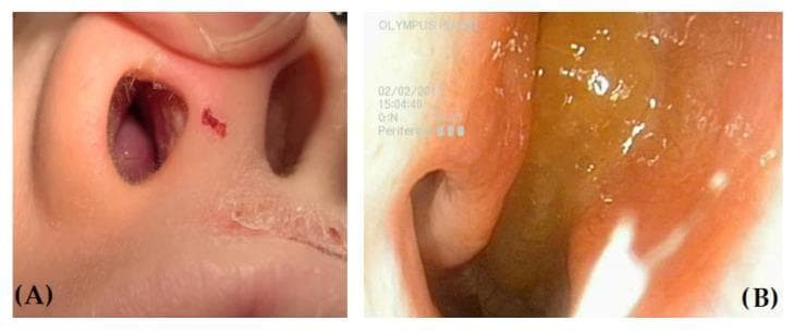 This clinical comparison features two images illustrating differential findings in the nasal cavity via anterior rhinoscopy and endoscopy. Image A shows a child's nose with a markedly hypertrophic right inferior turbinate, appearing as a fleshy, smooth, pinkish mass firmly attached to the lateral nasal wall; the external nares show signs of atopic dermatitis with dry, peeling skin. Image B provides a close-up endoscopic view of a nasal polyp (NP). The polyp is characterized by a yellowish, translucent, and gelatinous appearance with a rounded, grape-like morphology, distinct from the surrounding mucosa. This comparison is educational for differentiating benign inflammatory masses like nasal polyps from edematous turbinate hypertrophy commonly seen in pediatric patients with allergic rhinitis. Key diagnostic features include the polyp's glistening, wet surface reflections versus the solid, uniform texture of the hypertrophic turbinate. Medical specialty: Otolaryngology (ENT). Target audience: Medical students and practitioners.