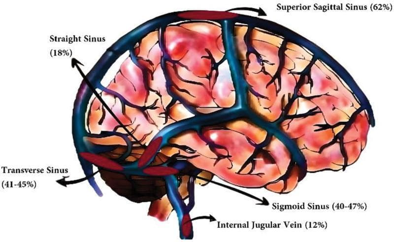 This medical illustration depicts the lateral view of the human brain with an anatomical overlay of the dural venous sinuses, highlighting the distribution and incidence of cerebral venous thrombosis (CVT). The venous structures are rendered in blue, superimposed on a reddish-toned representation of the cerebral hemispheres showing sulci and gyri. Key anatomical structures labeled include the superior sagittal sinus, straight sinus, transverse sinus, sigmoid sinus, and internal jugular vein. Each label is accompanied by a percentage indicating the reported incidence of thrombosis at that site based on clinical data. The superior sagittal sinus is identified as the most common site of involvement (62%), followed by the transverse (41-45%) and sigmoid (40-47%) sinuses. The diagram serves as an educational tool for neurology and radiology, illustrating the superficial and deep venous systems of the brain and their relative susceptibility to thrombotic events. It effectively demonstrates the confluence of sinuses and the drainage pathway into the internal jugular vein within a clinical context.