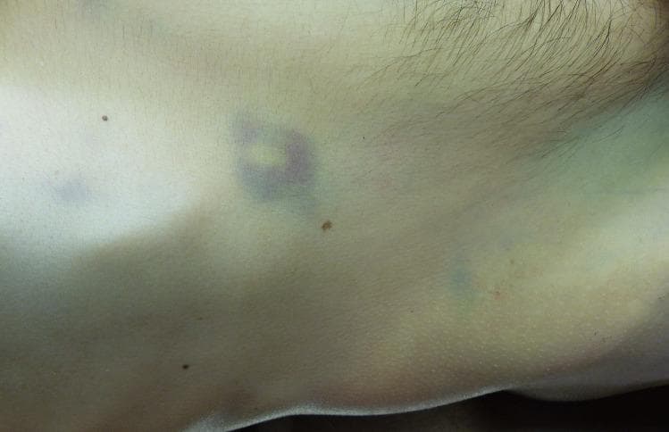 This clinical photograph shows a close-up view of the right flank of a patient, exhibiting distinctive skin discoloration. The primary finding is a livid, bluish-purple ecchymosis with a central yellowish hue, localized near the costal arch. This morphological pattern is characteristic of Grey Turner sign (and its variations like Fox sign), which represents subcutaneous retroperitoneal hemorrhage. The discoloration is irregular in shape, with a notable ring-shaped intensity in the central-left portion of the image. The surrounding skin appears pale, suggesting systemic anemia. Several small, benign-appearing melanocytic nevi are scattered across the torso. In an educational context, this visual finding is a clinical marker of severe underlying pathology, most commonly associated with acute necrotizing pancreatitis, where pancreatic enzymes cause retroperitoneal bleeding that track through fascial planes to the skin. The image serves as an important diagnostic sign for medical students and clinicians to recognize potential abdominal emergencies and internal hemorrhaging.