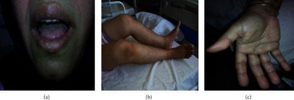 A three-part clinical photograph series demonstrating physical manifestations of systemic amyloidosis. Panel (a) presents an oral view showing macroglossia (enlarged tongue) with characteristic lateral scalloping, where tooth indentations are visible along the tongue's margins. Panel (b) shows the lower extremities of a patient in a supine position, highlighting a flexion contracture of the knee joint and associated muscle stiffness. Panel (c) displays a palmar view of the hand, illustrating sclerodactyly with thickened, stiffened skin on the palm and tapering of the fingers. These multi-system findings—encompassing macroglossia, joint contractures, and skin changes resembling scleroderma—are classic clinical signs of AL amyloidosis (light chain amyloidosis) and related plasma cell dyscrasias. The imagery serves as an educational resource for identifying the diverse musculoskeletal and soft tissue presentations of systemic amyloid deposition.