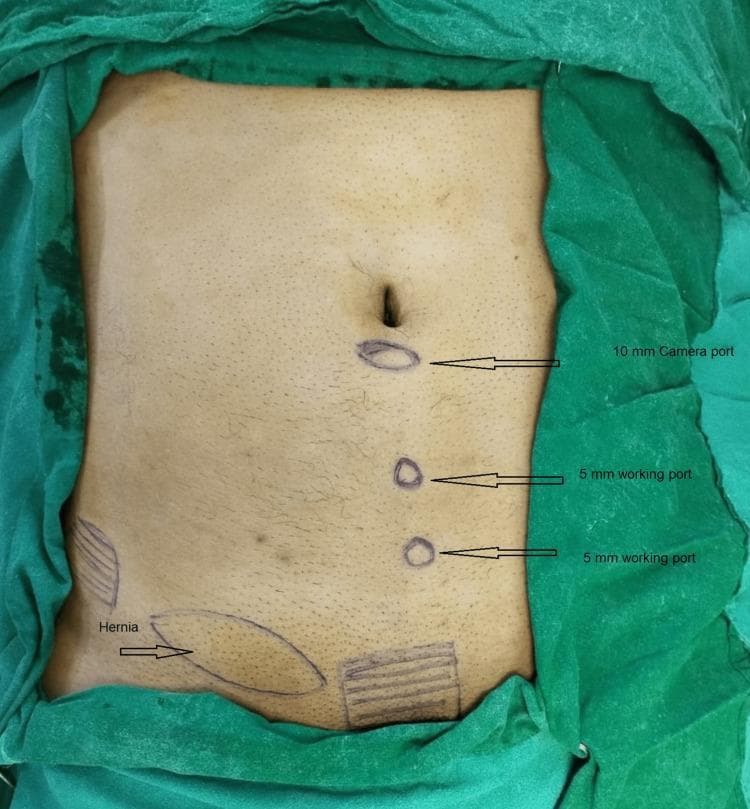 A clinical photograph of a patient's abdomen prepared for a surgical procedure, specifically illustrating the port placement for a classical totally extraperitoneal (TEP) inguinal hernia repair. The image shows surgical markings on the skin within a sterile green drape field. Three primary port locations are arranged vertically along the midline of the abdomen: a 10-mm camera port located just below the umbilicus, followed inferiorly by two 5-mm working ports. On the patient's lower right side (viewer's left), an ovoid marking identifies the location of the 'Hernia'. Additional geometric and hashed markings are visible in the lower abdominal and suprapubic regions, likely representing anatomical landmarks, planned dissection boundaries, or reinforcement zones for mesh placement. This visual is designed to teach the standard midline port configuration used to access the preperitoneal space while avoiding intra-abdominal entry during laparoscopic hernia surgery.