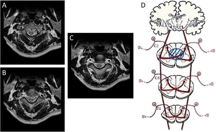 This composite educational image illustrates the radiological and pathophysiological features of Central Cord Syndrome. Panels A, B, and C present three sequential cranial-to-caudal axial T2-weighted MRI scans of the cervical spine at the C2-3 level. These images reveal a focal area of hyperintensity (high signal) localized in the central portion of the spinal cord, corresponding to the central canal and surrounding gray matter. Panel D is a neuroanatomical schematic diagram illustrating the lateral spinothalamic tracts across C2, C8, and T4 spinal levels. A blue circle highlights a central lesion at the C2 level, specifically demonstrating how the injury interrupts the decussating fibers of the spinothalamic tract as they cross the anterior white commissure. This visual correlation explains the mechanism of bilateral neuropathic pain and sensory deficits localized to the dermatome level of the injury (C2) while sparing more laterally located ascending tracts. The content serves to teach the clinical-radiological correlation of traumatic spinal cord injuries and the functional anatomy of sensory pathways within the spinal cord.