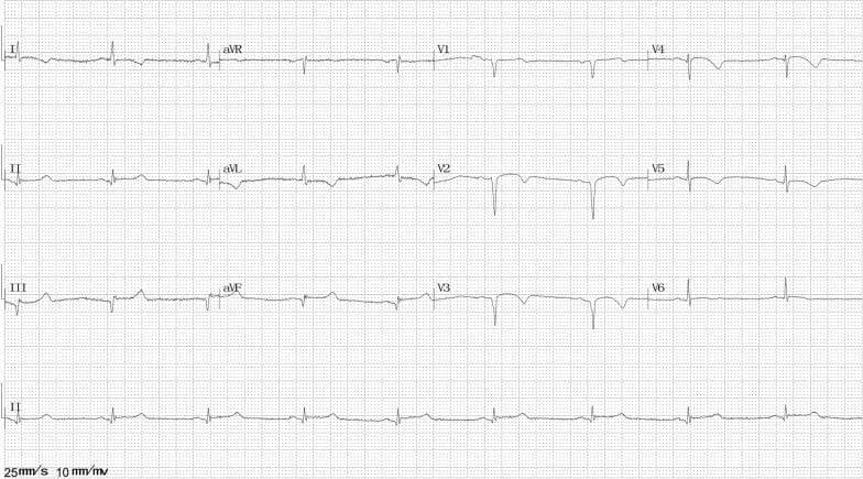 This diagnostic image is a 12-lead electrocardiogram (ECG) recorded at a standard paper speed of 25 mm/s and voltage of 10 mm/mV. The tracing demonstrates significant acute electrophysiological changes across multiple vascular territories. Notably, there is ST-segment elevation visible in the inferior leads (II, III, and aVF) and the anterior precordial leads (V1 through V4), indicating transmural myocardial injury. The precordial leads also show a pattern of poor R-wave progression and deep S-waves in V2-V3. The presence of concurrent inferior and anterior ST-segment elevation is a clinically significant finding that may suggest a large territory of ischemia or multivessel coronary artery spasm (CAS), as seen in Prinzmetal angina or Takotsubo cardiomyopathy variants. The rhythm appears to be sinus, and the visual focus is on the repolarization abnormalities that characterize the acute episode. This ECG serves as a critical educational tool for identifying extensive ST-segment elevation myocardial infarction (STEMI) patterns and differentiating coronary vasospasm from fixed atherosclerotic occlusion.