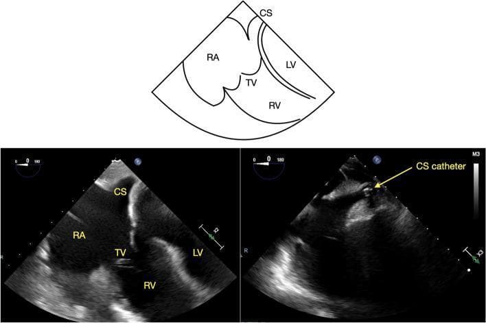 This diagnostic visual includes a side-by-side comparison of transesophageal echocardiography (TEE) images and an anatomical diagram depicting the mid-esophageal four-chamber (ME 4C) view. The educational focus is the visualization of the coronary sinus (CS) in its long axis. Key anatomical structures labeled include the right atrium (RA), right ventricle (RV), left ventricle (LV), and the tricuspid valve (TV). The left image demonstrates the normal ultrasound appearance of the CS as a clear, hypoechoic tubular structure positioned superior to the attachment of the tricuspid valve septal leaflet to the interventricular septum. The right image shows the clinical application of this view for monitoring catheterization, featuring a highly echogenic (bright) CS catheter positioned within the vessel. The accompanying line diagram provides a simplified schematic of these spatial relationships, emphasizing the CS's proximity to the RA and its orientation relative to the four cardiac chambers. This content is intended for advanced medical trainees learning TEE imaging protocols for electrophysiology or cardiac surgery.