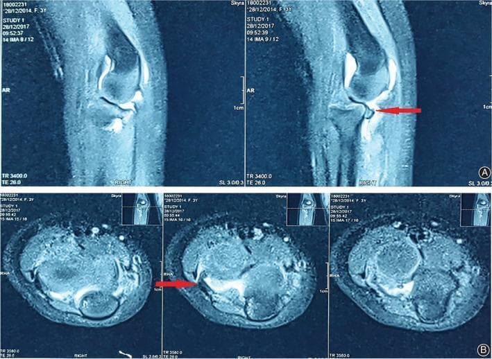This diagnostic image consists of multi-planar T2-weighted MRI scans of a human elbow joint, presented in sagittal (A) and axial (B) views. The scans demonstrate the complex anatomy of the radiohumeral (humeroradial) joint, showing the distal humerus, proximal radius, and ulna. A prominent clinical finding is highlighted by red arrows in both views: a localized area of low signal intensity representing the annular ligament, which has become incarcerated or 'stuck' within the radiohumeral joint space. In the sagittal view, this interposed soft tissue is seen disrupting the normal articulation between the radial head and the humeral capitellum. In the axial slices, the displaced ligament is visualized as a dark, hypointense structure contrasting against the brighter (hyperintense) joint fluid. This finding is characteristic of a complex radial head dislocation where soft tissue entrapment prevents successful closed reduction. The image is a critical educational resource for understanding mechanical blocks in pediatric elbow trauma and the utility of MRI in identifying ligamentous interposition.