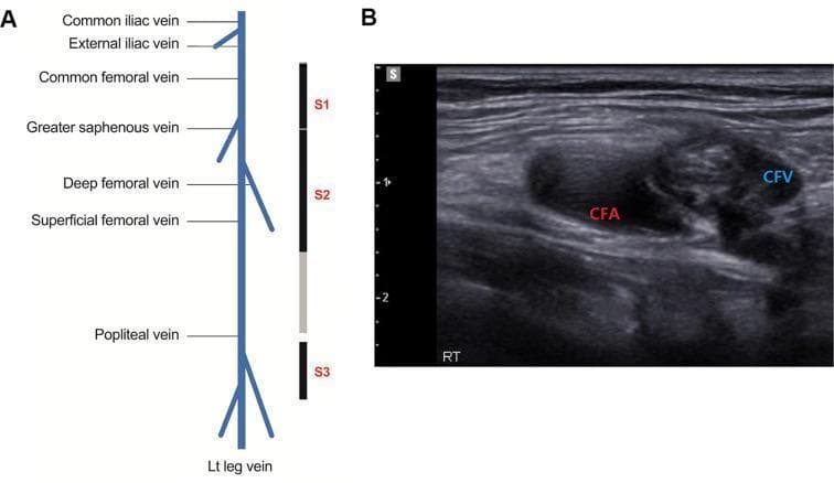 This composite educational graphic details a 3-point point-of-care ultrasound (POCUS) protocol for diagnosing deep vein thrombosis (DVT) in the lower extremities. Panel A contains an anatomical diagram of the left leg venous system, labeling the common iliac, external iliac, common femoral, greater saphenous, deep femoral, superficial femoral, and popliteal veins. It illustrates three primary scanning sites: Site 1 (S1) covering the common femoral vein to the greater saphenous bifurcation; Site 2 (S2) covering the proximal superficial and deep femoral segments; and Site 3 (S3) covering the popliteal vein to the trifurcation. Panel B shows a transverse B-mode diagnostic ultrasound image of the right inguinal region. The image demonstrates a common femoral artery (CFA) adjacent to a common femoral vein (CFV). The CFV appears non-compressible with internal hyperechoic material, indicative of an acute venous thrombus. This visual comparison highlights the key POCUS diagnostic criteria for DVT: non-compressibility of the venous lumen under probe pressure. This material is designed for medical training in emergency medicine and vascular radiology.