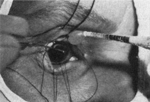 This monochrome clinical photograph captures an intraoperative view of a cryoextraction procedure for lens removal, a historical technique for intracapsular cataract extraction (ICCE). The image shows a close-up of the human eye with the surgical field prepared. A specialized cryoprobe, characterized by its cylindrical shape and alternating dark and light banded markings, is positioned horizontally from the lateral aspect, with its tip in direct contact with the superior portion of the crystalline lens. Multiple traction sutures are visible, anchored to the episclera or limbal area to retract the globe and provide surgical exposure. The anatomical structures depicted include the dilated pupil revealing the intumescent cataract, the limbus, and partially retracted eyelids. The educational focus of this image is to demonstrate the application of low-temperature instruments to adhere to and extract the lens capsule and its contents intact, primarily used in ophthalmic surgery before the advent of modern phacoemulsification.