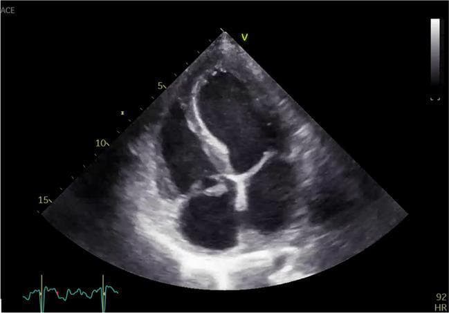 Transthoracic echocardiogram (TTE) in an apical four-chamber view demonstrating infective endocarditis of the tricuspid valve. The diagnostic image shows a prominent, irregularly shaped, and highly echogenic mass (vegetation) attached to the tricuspid valve leaflets. The vegetation exhibits a heterogeneous texture and appears to be broad-based with a possible stalk-like extension protruding into the right atrium. Notable features include thickening of the valve leaflets and evidence of valvular distortion or prolapse, characteristic of active endocarditis. The surrounding right heart chambers are visible, providing anatomical context for the right-sided valvular pathology. This image serves as a clinical example of the ultrasonic appearance of vegetations, crucial for the diagnosis of right-sided infective endocarditis, often associated with intravenous drug use or indwelling cardiac devices.
