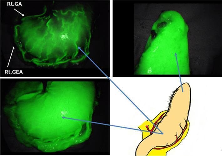 This composite figure illustrates the circulatory network of a subtotal stomach (SS) during reconstructive surgery using indocyanine green (ICG) fluorescence imaging. The panel consists of three intraoperative clinical photographs and one anatomical diagram. The ICG fluorescence images demonstrate a vibrant, dense, and interconnected vascular network beneath the gastric mucosa, indicating robust perfusion. Key arterial landmarks are labeled: the Right Gastric Artery (Rt. GA) is visible along the lesser curvature, and the Right Gastro-Epiploic Artery (Rt. GEA) is identified along the greater curvature. These primary vessels and their preserved arteriovenous arcades exhibit high-intensity fluorescence, branching into a complex capillary bed that ensures uniform tissue viability up to the tip of the gastric conduit. The anatomical diagram correlates these fluorescent findings with the surgical anatomy, highlighting the vascular supply (red) and the longitudinal orientation of the subtotal stomach. This imaging modality serves as an intraoperative tool for real-time assessment of blood flow, which is critical for minimizing anastomotic complications in esophageal or gastric reconstruction.