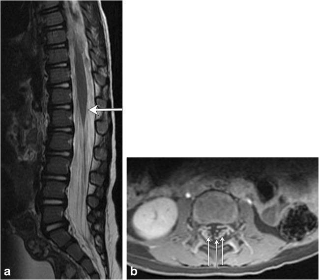 This composite diagnostic image showcases MRI findings associated with Guillain-Barré syndrome (GBS) in a pediatric patient. Figure (a) is a sagittal T2-weighted MRI of the thoracolumbar spine, demonstrating a subtle, localized area of increased signal intensity (hyperintensity) at the level of the conus medullaris (indicated by an arrow). Figure (b) provides an axial T1-weighted post-contrast MRI of the lumbar spine, revealing prominent enhancement of multiple nerve roots within the cauda equina (indicated by multiple arrows). These visual features correlate with the typical inflammatory and autoimmune pathophysiology of GBS, which affects the peripheral nervous system and nerve roots. The presence of nerve root enhancement on post-contrast imaging is a key diagnostic indicator in clinical neurology. The images serve to illustrate how MRI can support the diagnosis of GBS by identifying involvement of the lower spinal cord and emerging nerve roots in patients presenting with progressive ascending weakness or paralysis.