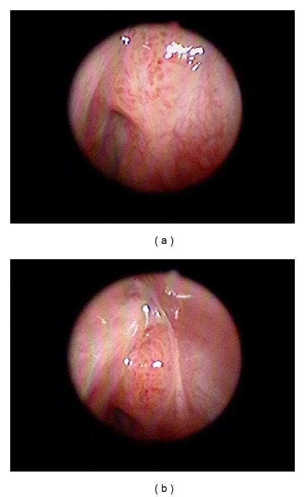 This clinical image presents two sinoscopic (endoscopic) views, labeled (a) and (b), of the nasal cavity. The imaging demonstrates a sinonasal inverted papilloma that has undergone malignant transformation. The mucosal lining is predominantly pinkish-red, indicating significant vascularity and underlying inflammation. Central to both views is an abnormal, localized tissue lesion characterized by an irregular, exophytic texture with subtle folds and crevices. Notable visual features include prominent surface vascularization and small red punctate spots, which are typical of the increased angiogenesis seen in neoplastic changes. The overall visual impression is one of disordered mucosal architecture and tumor growth within the sinonasal region. These endoscopic findings are clinically significant for identifying premalignant or malignant progression in patients with recurrent inverted papillomas, necessitating further histological evaluation for squamous cell carcinoma transformation.
