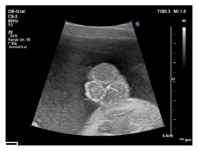 This diagnostic 2D ultrasound image captures a fetal perineum in a transverse-oblique plane, focusing on the external male genitalia to demonstrate signs of severe hypospadias. The image reveals a shortened penis with ventral angulation, positioned between two prominent scrotal folds—a configuration often referred to as the 'tulip sign' in prenatal sonography. Both testes are visible within the scrotal sacs. A white arrow indicates the anomalous, proximal localization of the urethral meatus, suggesting a third-degree (perineoscrotal) hypospadias. The clinical significance of this finding lies in the prenatal detection of genital malformations, which allows for early pediatric surgical consultation and planning for reconstruction. The visualization of the blunted, bulbous tip of the penis and its ventral orientation relative to the bifid scrotum are key diagnostic features shown here, characteristic of advanced-level obstetric and fetal morphology examinations.