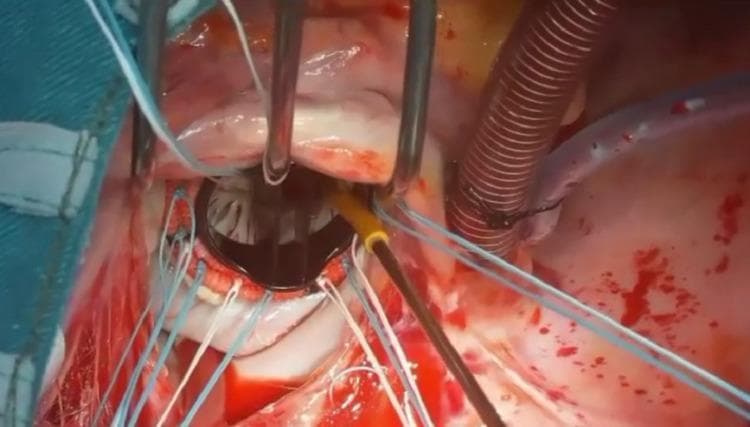This clinical photograph captures an intraoperative view of a mitral valve replacement (MVR) using an eversion surgical technique. Centrally positioned within the left atriotomy is a St. Jude Masters bileaflet mechanical prosthetic valve. The valve features two dark carbon leaflets within a low-profile circular housing, surrounded by a sewing cuff. Multiple blue and white 2-0 polyester mattress sutures are visible, anchored through the mitral annulus and the prosthetic sewing ring to secure the valve in place. The surgical field includes specialized cardiac instruments, such as a metal retractor with three curved prongs providing exposure of the atrial chamber. In the upper right quadrant, surgical tubing and a ribbed cannula related to cardiopulmonary bypass or suction are visible. The surrounding cardiac tissue is partially covered by remnants of the native mitral valve leaflets, which have been everted to facilitate the implantation of a larger prosthetic valve. This image demonstrates key steps in advanced valvular cardiac surgery, emphasizing prosthetic seating and suture management.