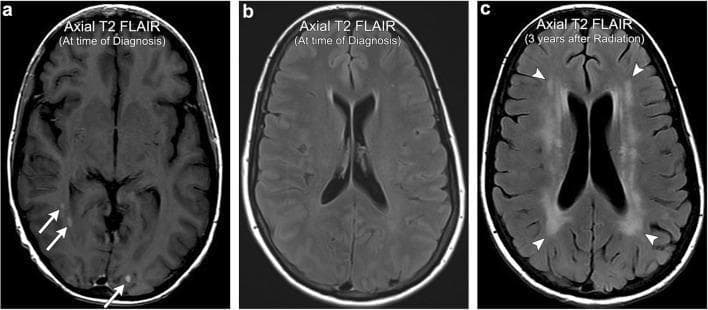 This diagnostic imaging sequence consists of three axial T2-weighted Fluid-Attenuated Inversion Recovery (FLAIR) MRI scans of the brain, illustrating the progression of radiation-induced leukoencephalopathy. Images (a) and (b), labeled 'At time of Diagnosis', show focal, punctate hyperintensities in the subcortical white matter (indicated by arrows), representing metastatic thyroid carcinoma. Image (c), labeled '3 years after Radiation', demonstrates a dramatic interval change following whole-brain radiation therapy (WBRT). There is now extensive, symmetric, and confluent T2 FLAIR hyperintensity within the periventricular white matter (indicated by arrowheads). A hallmark feature visible in image (c) is the relative sparing of the subcortical U-fibers, which distinguishes this condition from other leukoencephalopathies such as Progressive Multifocal Leukoencephalopathy (PML). The imaging findings are consistent with chronic, non-necrotic white matter injury secondary to radiation, characterized by progressive cognitive decline in a clinical context.