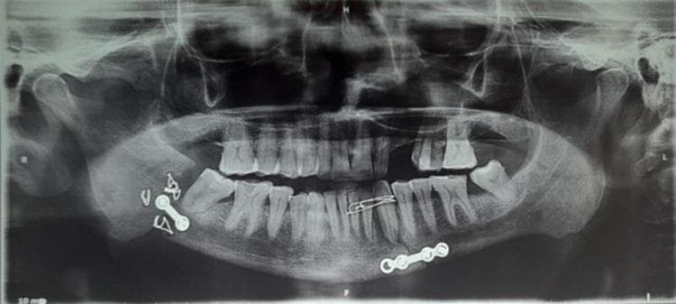 This diagnostic image is a panoramic radiograph (orthopantomogram or OPG) of the human mandible and maxilla. The imaging reveals significant pathology at the right mandibular angle, characterized by a clear cortical discontinuity and radiolucent gap consistent with a non-union of a mandibular fracture. Multiple radiopaque internal fixation devices are visible: a small two-hole metallic plate with screws and several transosseous wires are positioned at the right mandibular angle near the fracture site. Another four-hole metallic plate is fixed at the left mandibular parasymphysis. Additionally, interdental wiring is noted in the anterior maxillary segment, specifically connecting teeth in the upper left quadrant (region of teeth 22 to 24). The radiograph demonstrates clinical findings relevant to oral and maxillofacial surgery, illustrating post-surgical complications and the positioning of osteosynthesis hardware in the treatment of facial trauma.