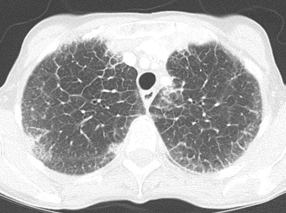 This diagnostic image is an axial high-resolution computed tomography (HRCT) scan of the chest shown in lung window. The scan demonstrates diffuse, bilateral abnormalities within the lung parenchyma, primarily characterized by significant smooth thickening of the interlobular septa. This results in a prominent reticular pattern throughout both lung fields. Additionally, there is evidence of peribronchovascular interstitium thickening, visualized as increased density and haziness surrounding the pulmonary vessels and bronchial structures. Small peripheral areas suggest the beginning of architectural distortion, though the overall appearance is dominated by the interstitial septal lines. These findings are clinically significant in the evaluation of interstitial lung diseases, pulmonary edema, or lymphangitic carcinomatosis. In this specific clinical context, these features represent pulmonary manifestations of amyloidosis. The image serves as an educational example of diffuse interstitial thickening and the resulting alteration of normal lung architecture as seen on diagnostic radiology.