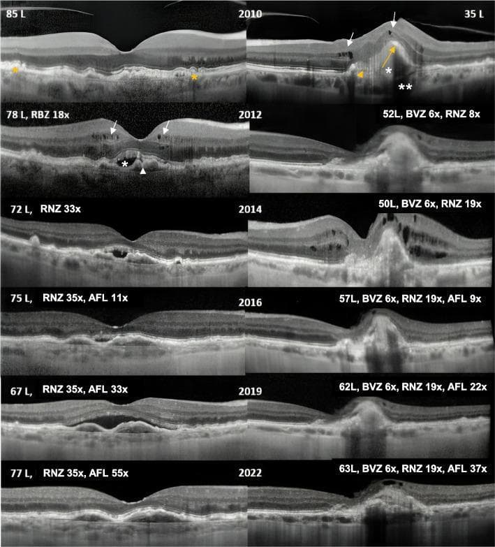 This figure presents a longitudinal comparative timeline of spectral-domain optical coherence tomography (OCT) macular scans for the right eye (RE, left column) and left eye (LE, right column) over a 12-year period (2010–2022). The series documents the progression and management of neovascular age-related macular degeneration (nAMD). At the 2010 baseline, the LE shows advanced pathology including a large pigment epithelial detachment (PED), subretinal hyper-reflective material (SHRM), intraretinal fluid (IRF) cysts, and underlying RPE atrophy with transmission defects. In contrast, the RE baseline demonstrates only drusen. By 2012, the RE develops exudative signs including subretinal fluid (SRF) and IRF. Subsequent scans from 2014 to 2022 track the morphological evolution under anti-VEGF therapy (Ranibizumab, Bevacizumab, and Aflibercept, as indicated by labels). The timeline illustrates fluctuating fluid levels and eventual stabilization, with the RE showing a relatively preserved foveal contour and the LE exhibiting chronic architectural distortion, subretinal fibrosis, and RPE atrophy by 2022. Annotations highlight specific features: white arrows for IRF, asterisks for SRF/SHRM, and orange markers for RPE/PED abnormalities.