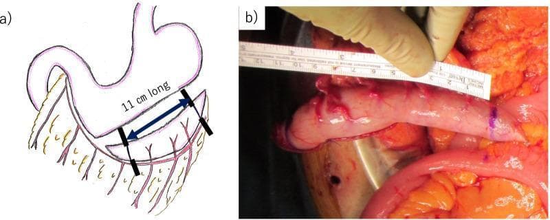 This composite figure illustrates the surgical creation of a gastric conduit for urinary diversion. Panel A is an anatomical diagram showing the stomach and the vascular supply of the greater curvature, specifically the gastroepiploic artery. A blue double-headed arrow and text indicate the 11-cm longitudinal section along the greater curvature targeted for conduit formation, starting approximately 2 cm proximal to the pylorus. Panel B is an intraoperative clinical photograph providing a surgical view of the mobilized gastric conduit. The conduit appears as a pinkish-red, vascularized tubular structure. A surgical ruler is held by a gloved hand alongside the tissue, confirming a length of approximately 11 cm. The conduit maintains its blood supply from the right gastroepiploic artery to ensure viability for subsequent ureterogastric anastomosis. This material demonstrates a specialized reconstructive technique used in complex pelvic surgeries, such as total pelvic exenteration, where standard urinary diversion methods like an ileal conduit may not be feasible.